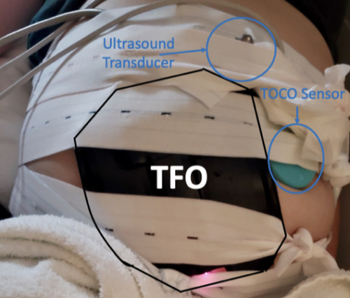 Picture of TFO on Humans